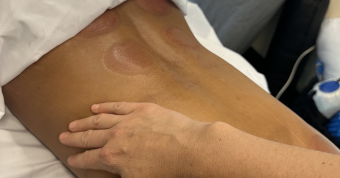 What Is Physical Therapy for Lymphedema and How Can It Help Reduce Swelling?