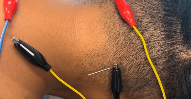 Finding Relief After Breast Cancer: How Dry Needling with E-Stim Can Help Chronic Chest Wall Pain image